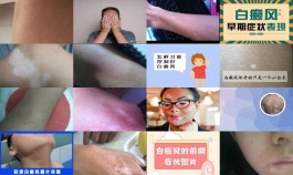 【 白点癫风的初期图】白点癫风的初期长在什么地方  